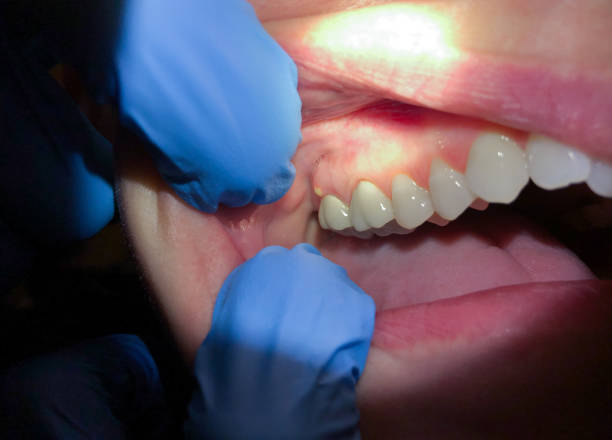 Best Emergency Treatment for Toothache in Broad Brook, CT