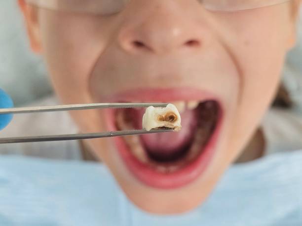 Best Emergency Wisdom Teeth Removal in Broad Brook, CT